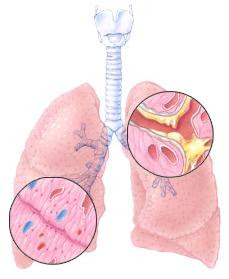 Remedio natural para sacar las flemas de los pulmones